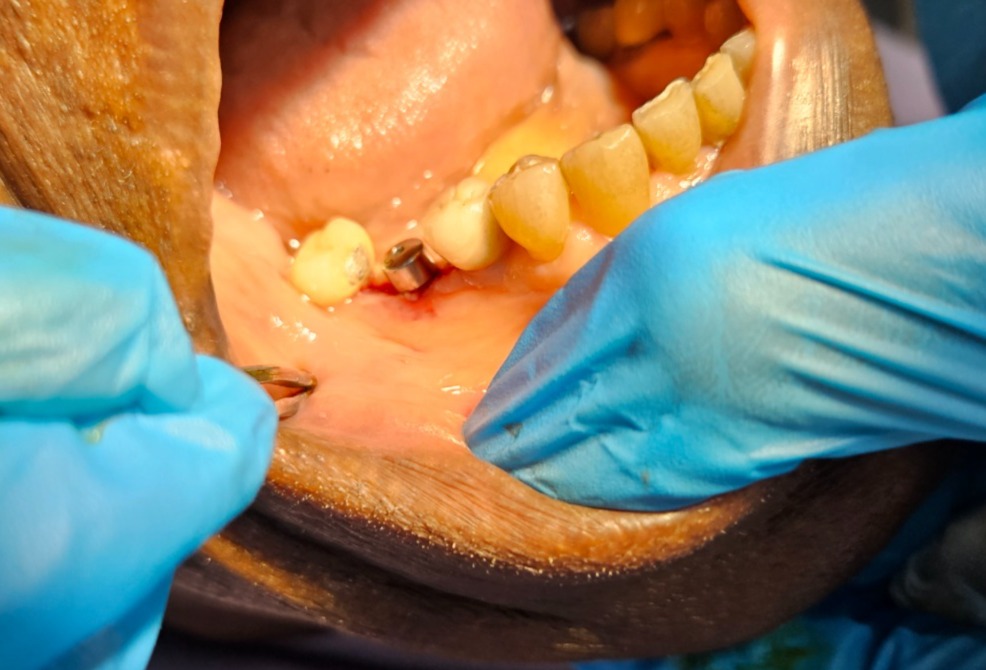 Pose d'implant dentaire en cours au Cabinet Le Sourire, Douala