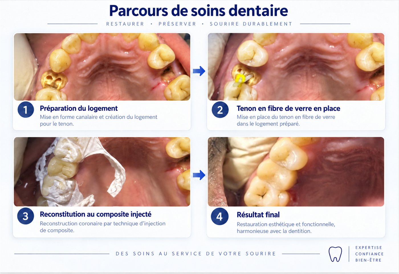 Reconstitution coronaire par composite injecté — Cabinet Le Sourire, Douala